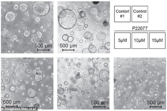 Researchers tested this new treatment mechanism through molecular cell experiments in lab-grown mini-tumors, or organoids, made from colon cancer cells. Their 'switch' stopped cancer growth (top left) and reverted cells back to a health state (bottom right)