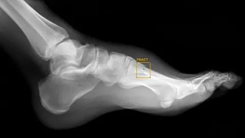 Peter MacMahon AI identifies a fracture in a scan of a foot